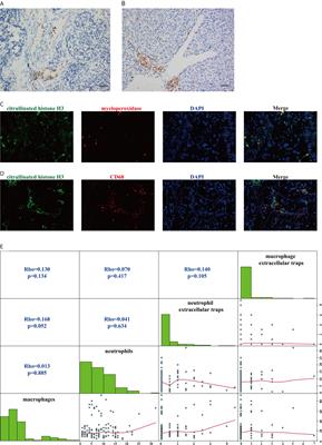 Neutrophil Extracellular Traps and Macrophage Extracellular Traps Predict Postoperative Recurrence in Resectable Nonfunctional Pancreatic Neuroendocrine Tumors